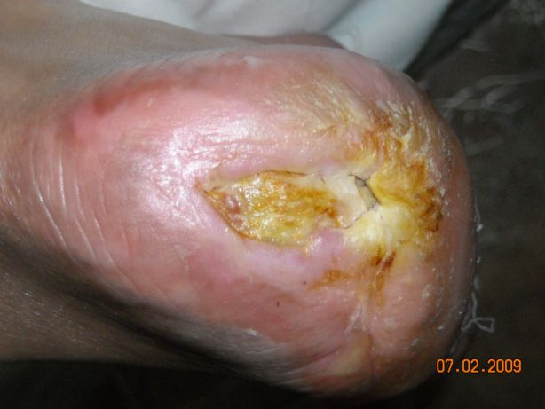La dermatite di atopic e la diatesi che trattare